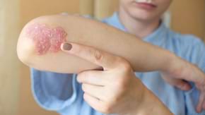 Artrita psoriazica: ce este, cum se manifesta si noutati in tratament