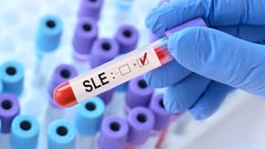 Principii de diagnostic in lupusul eritematos sistemic