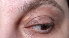 Xantoamele: cauze, diagnostic si tratament