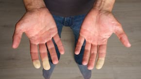 Fenomenul Raynaud, ce este și pe cine poate afecta?