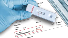 Testul de salivă care &icirc;ți spune rapid și ușor dacă ai Hepatită C