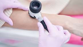 Dermatoscopia in evaluarea nevilor