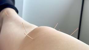 Acupunctura ajuta in durerea cronica de genunchi?
