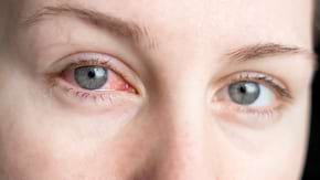 Conjunctivita bacteriana: cauze, simptome, tratament