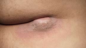 Chist pilonidal: cauze, simptome, tratament