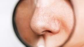 Punctele negre: cum le elimini natural?