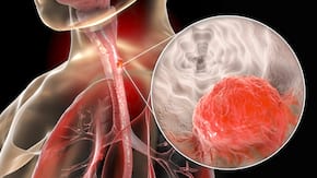 Cancerul esofagian, locul sase in lume in topul mortalitatii prin cancer