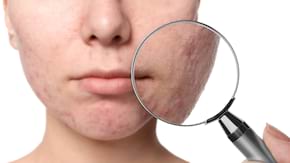 5 obiceiuri care contribuie la cicatricile aparute dupa acnee