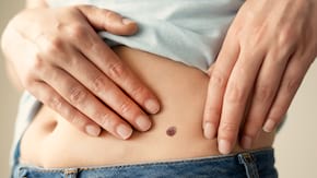 Autoexaminarea aluniţelor – efectuarea corectă ne poate salva viaţa