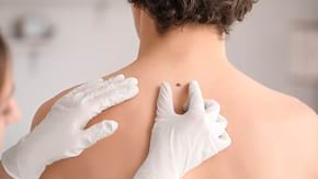 Bărbații, mai expuși melanomului decât femeile