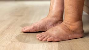 Picior diabetic: cauze, simptome, tratament