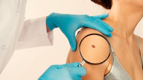 Tot ce trebuie să știi despre noul vaccin personalizat împotriva melanomului