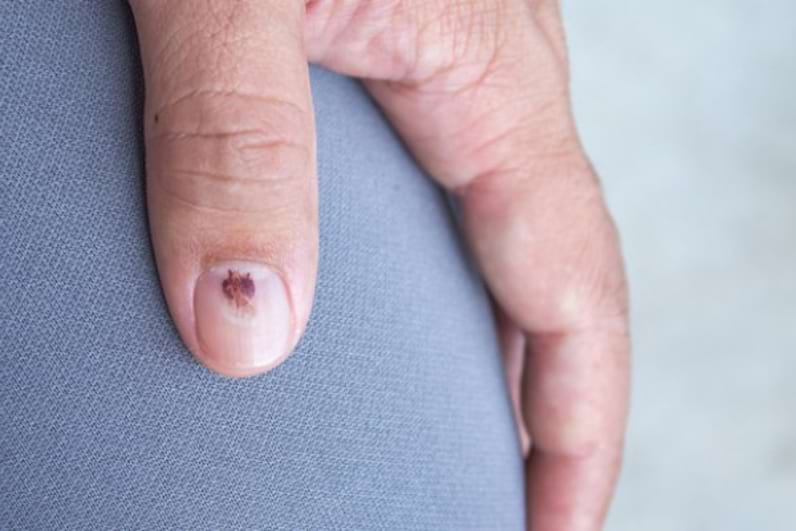 Iritația de scutec provocată de candida și alte ciuperci de piele la copii