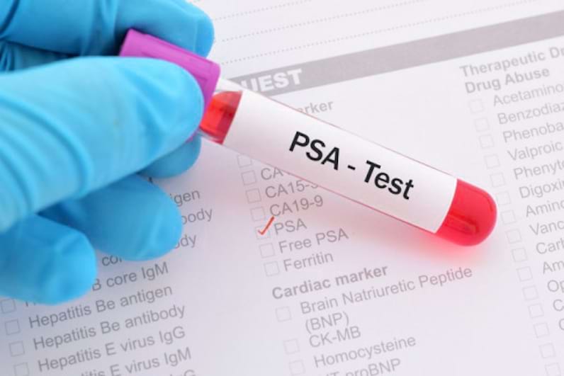 PSA (antigen specific prostatic) si free-PSA
