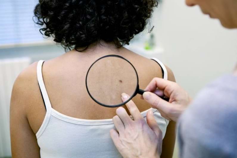 Cancerul de piele, prevenire și recomandări date de terapeuții chinezi