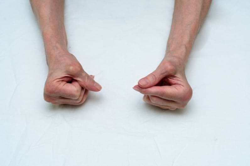 poliartrita reumatoida genunchi artrita deformantă a mâinilor și tratamentul acesteia