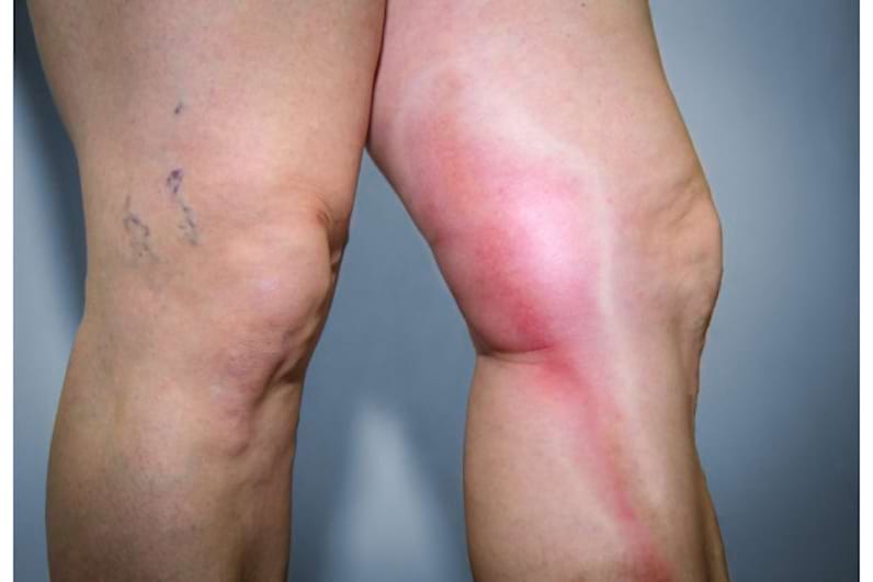 Scârțâit și durere la genunchi, Tratamentul cu varicoza pinsk
