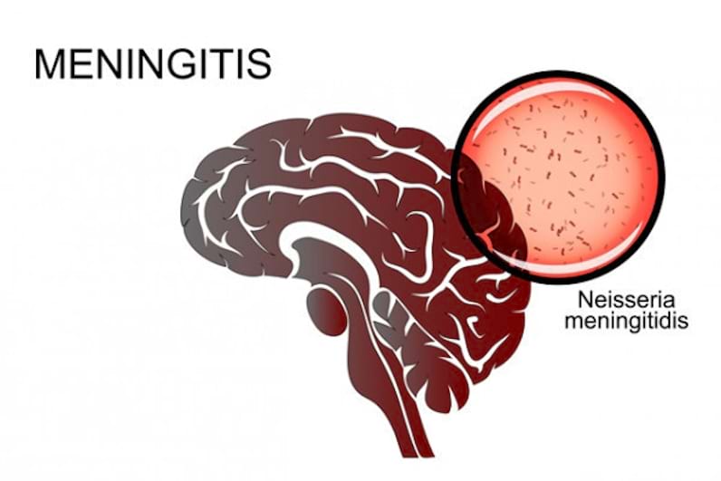 Meningita: cauze, simptome și tratament