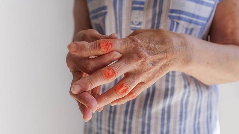 tratamentul artrozei mâinii stângi