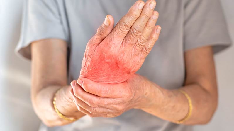 Deformarea mâinii în artrita reumatoidă