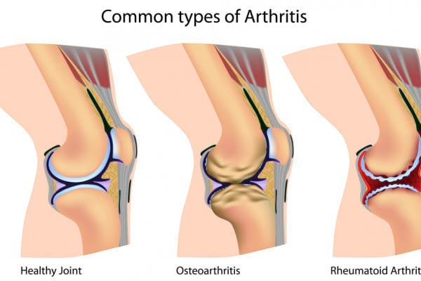 artrita și tratamentul șoldului