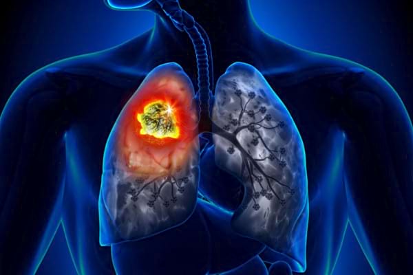 Legatura dintre aportul excesiv de vitamina B si cancerul pulmonar