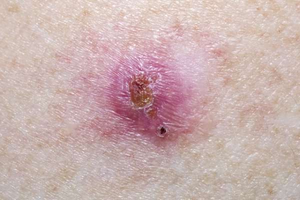 Simptomele cancerului de piele