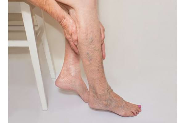 tratamentul pernei varicoase piciorul a strigat de la varicoza
