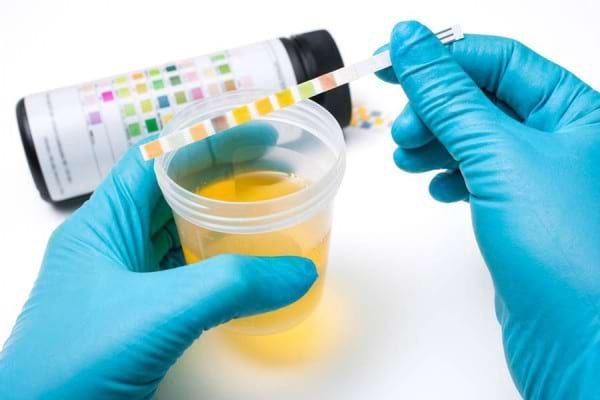 Cauze, simptome și tratamente ale urinei tulbure