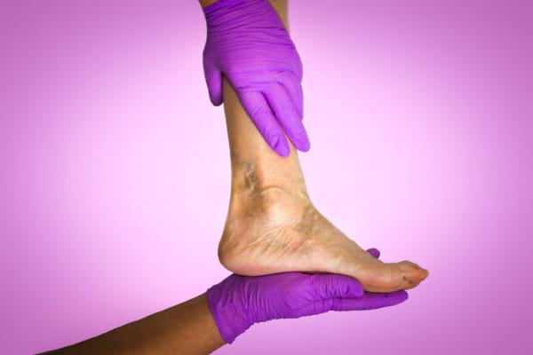 Eczema cu tratament pentru picioare varicoase