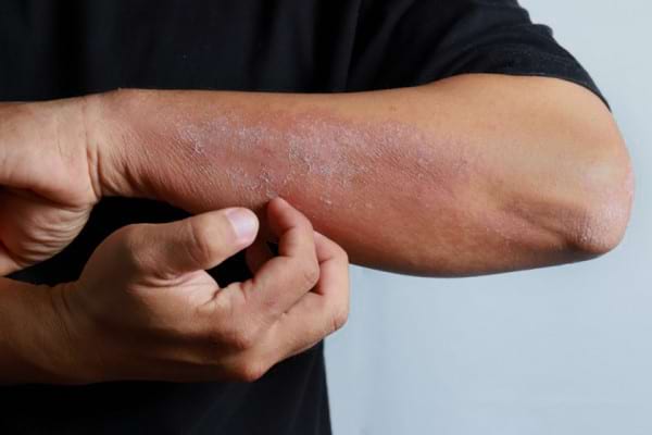 Top 10 Sfaturi Pentru Alimentatia In Dermatita Atopica