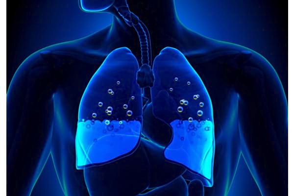 Edemul Pulmonar