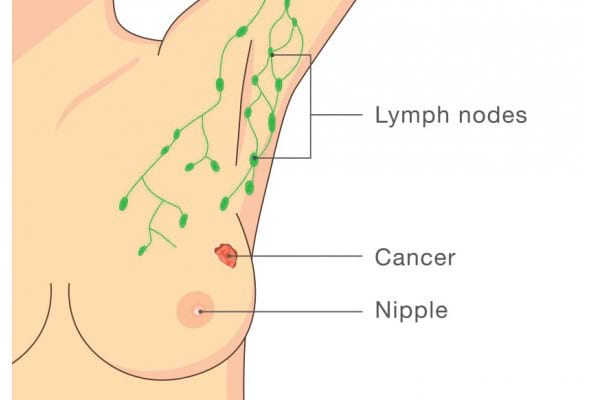 Biopsia ganglionului santinela in cancerul mamar