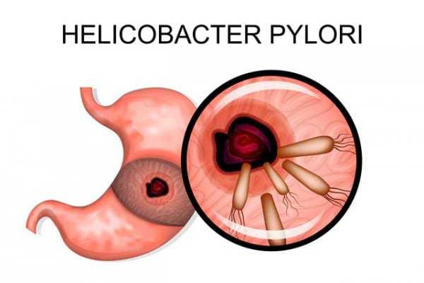 Cum poate bacteria Helicobacter pylori sa provoace cancer gastric