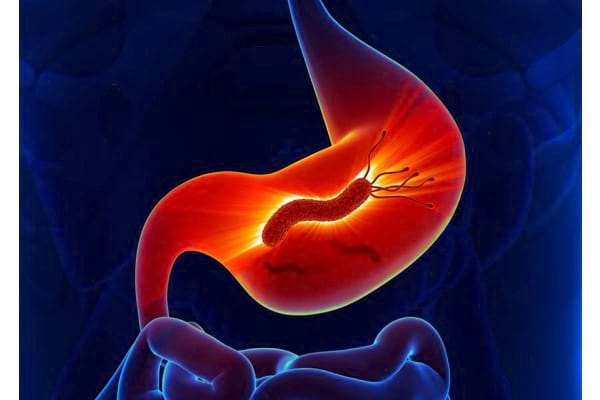 Ce Este Infecția Cu Helicobacter Pylori