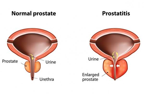simptome infectii prostata