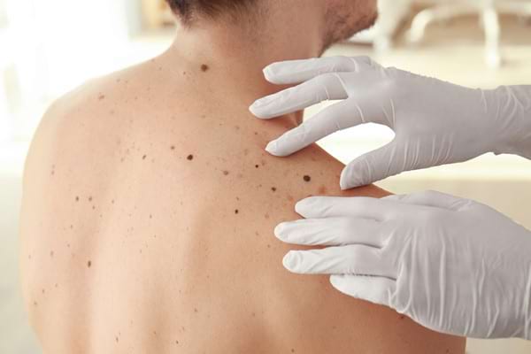 Melanomul Malign Familial Cauze Si Factori De Risc