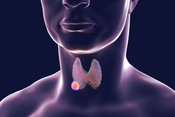 Neoplasmele Tiroidiene Nodulii Tiroidieni Cauze Simptome Tratament
