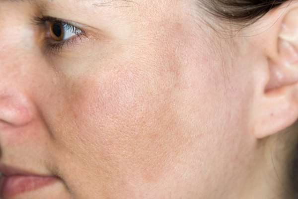 de ce apare pigmentarea pe față indepartarea ridurilor nazolabiale