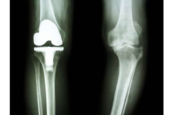la medici tratamentul artrozei genunchiului