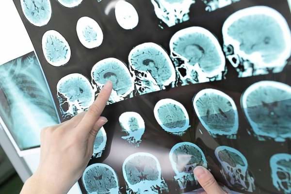Riscul De A Avea Un Al Doilea Accident Vascular Cerebral