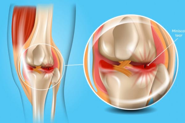 fisura menisc despre cea mai importantă artroză a genunchiului