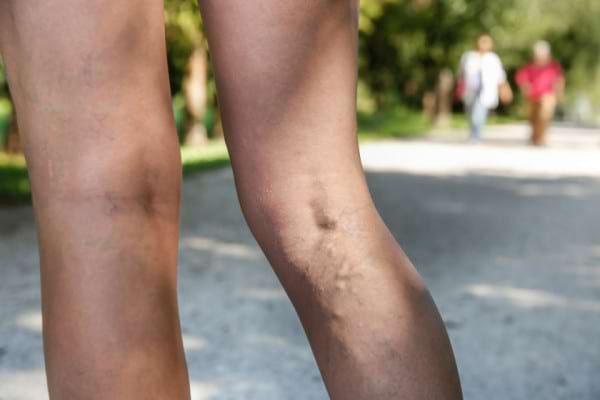cum se trateaza vene varicoase prin tratament folcloric remedii naturiste pentru picioare grele