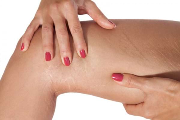 Cum să elimini vergeturile de pe picioare: creme, remedii populare și tratamente de salon