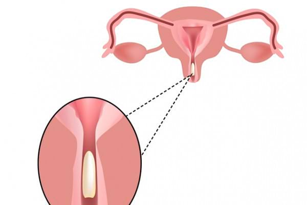 Candidoza Vaginal Cauze Simptome Tratament Ghidul Medicului My Xxx