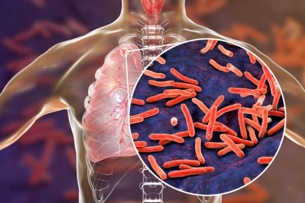 10 simptome ale tuberculozei