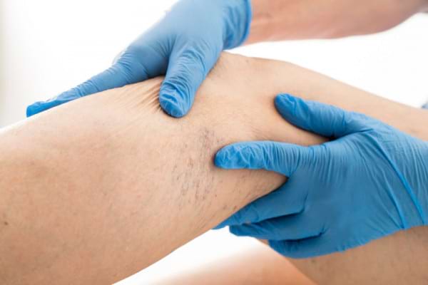 tratamentul eczemei pe picioare în varicoza)