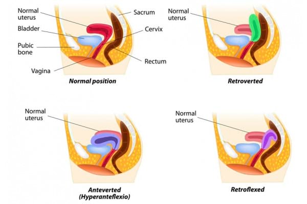 Uterul Retrovers Semnificație Diagnostic și Tratament