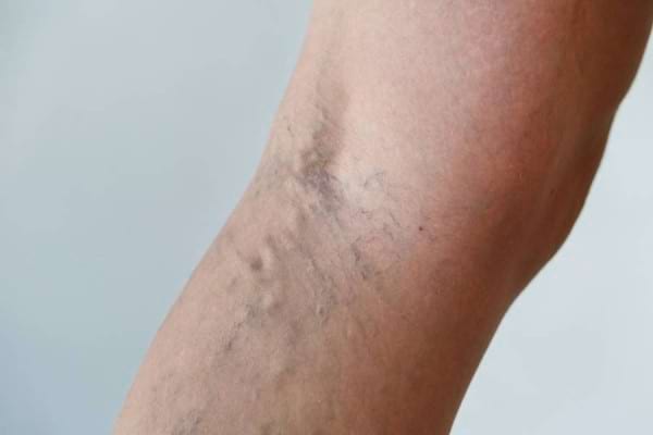 leziunile pielii în vene varicoase i tratament