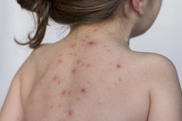 Ce se întâmplă când un adult face varicelă? Poate duce la pierderea definitivă a vederii